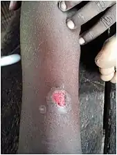 Ulcerated mother yaw