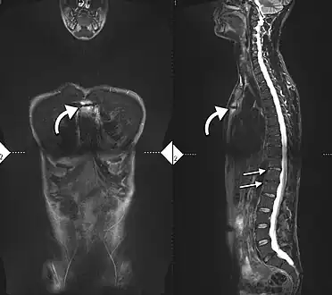 34-year-old male with AS. Inflammatory lesions of the anterior chest wall are shown. Inflammatory changes are seen in the lower thoracic spine and L1