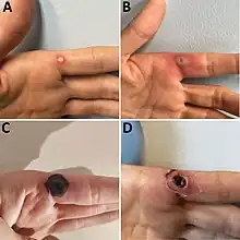 Progression of monkeypox after needlestick injury from a pustule at work[41]