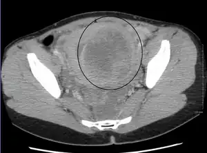 A very large (9&nbsp;cm) fibroid of the uterus which is causing pelvic congestion syndrome as seen on CT
