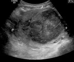 A very large (9&nbsp;cm) fibroid of the uterus which is causing pelvic congestion syndrome as seen on ultrasound