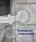 Acetabular anteversion. This parameter is calculated on a lateral radiograph as the angle between the transverse plane and a line going through the (anterior and posterior) margins of the acetabular cup.