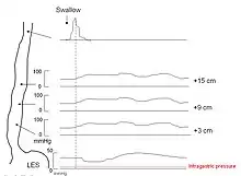 Schematic of manometry in achalasia showing aperistaltic contractions, increased intraesophageal pressure, and failure of relaxation of the lower esophageal sphincter.