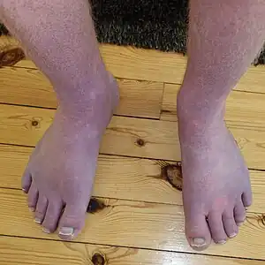 Acrocyanosis in Postural orthostatic tachycardia syndrome patient