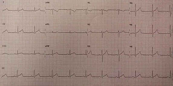 ECG showing slight ST elevation in many leads congruent with pericarditis