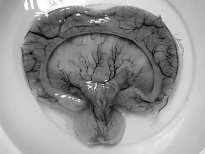 Gross pathology specimen from a case of alobar holoprosencephaly.