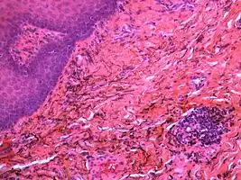 Silver sulfide deposits are found in proximity to small vessels in the oral mucosa