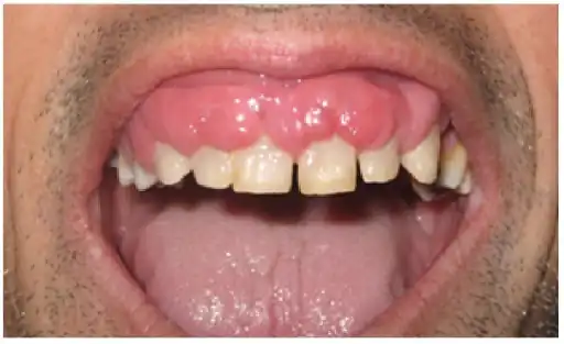 Generalized diffused gingival overgrowth