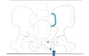 This fracture is best viewed anteriorly, while the other fractures are viewed superiorly. The arrow indicates where the force is coming from, and the colored lines indicate where the break occurs.