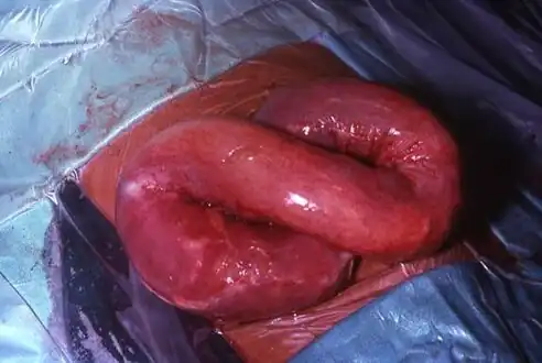 Ascaris infection: Antimesenteric splitting of the outer layers of the bowel wall due to a large amount of ascaris (South Africa)