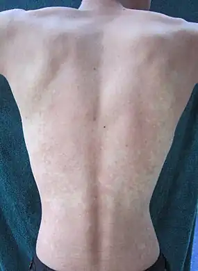 The back of an East Asian man showing alcohol flush reaction.