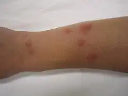 Bedbug bites