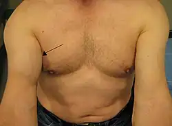 Rupture of the proximal biceps tendon. Note that the muscle have moved up.