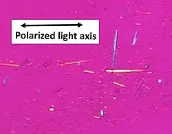 Uric acid crystals in polarized light, showing negative birefringence, with yellow color when aligned parallel to the axis of the red compensator, and blue when perpendicular.[54]
