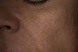 Individual with Birt–Hogg–Dubé syndrome, showing the characteristic facial fibrofolliculoma