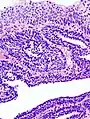 Histopathology representing an inverted papilloma of the urinary bladder that was cystoscopically resected. Hematoxylin and eosion stain.