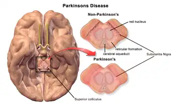Degradation of substantia nigra associated with Parkinson's disease.