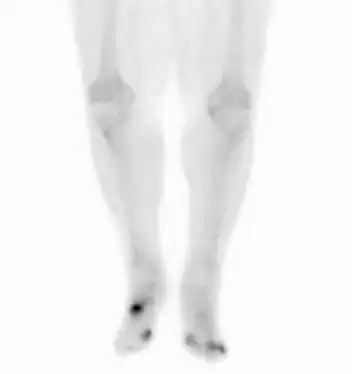 Osteomyelitis in both feet as seen on bone scan