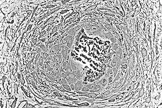 Light micrograph of undecalcified tissue displaying osteoblasts actively synthesizing rudimentary bone tissue (center)