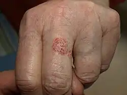 SCC in situ (Bowen's disease).