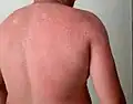 Skin peeling following sunburn