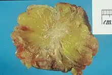 Excised human breast tissue, showing an irregular, dense, white stellate area of cancer 2&nbsp;cm in diameter, within yellow fatty tissue.