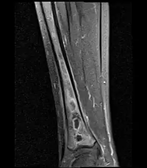 Sagittal T1-weighted fat-suppressed post gadolinium image showing the extent of the multiloculated intramedullary abscess.