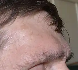 Brow ridge and forehead protrusion remaining after tumor removal and tissue swelling eliminated