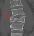 A burst fracture of L4 as seen on CT