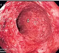 Endoscopic biopsy showing granulomatous inflammation of the colon in a case of Crohn's disease.