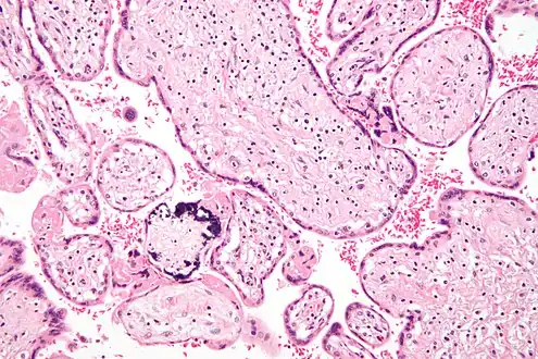 Micrograph of a placental infection (CMV placentitis)