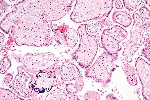 Micrograph of CMV placentitis