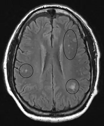 MRI image of the brain in vitamin B12 deficiency, axial view showing the "precontrast FLAIR image": note the abnormal lesions (circled) in the periventricular area suggesting white matter pathology.