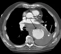 Contrast enhanced CT of a ruptured large (7&nbsp;cm) thoracic aneurysm, with black arrow indicating the aorta, and white arrow blood in the thorax