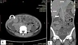 Lymphoma may appear as peritoneal lymphomatosis, as can be seen on CT scan. Image depicts non-Hodgkin lymphoma in a 17 year old who is HIV positive. A. Irregular homogenously enhancing wall thickening involving the ileocaecal region with aneurysmal dilatation of involved segments (curved arrow). B. Hepatosplenomegaly with liver metastasis (white arrows).[23]