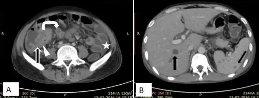 a,b)CT of abdominal tuberculosis[15]