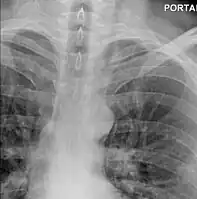 Upright chest radiography showing mediastinal air adjacent to the aorta and tracking cephalad adjacent to the left common carotid artery. This patient presented to the Emergency department with severe chest pain after eating.