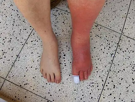 Example of cellulitis showing 3+ edema of left leg