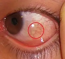 An eye with a mild swollen region of the conjunctiva (front view).