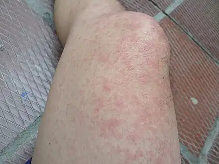 Chikungunya (lower extremeties)