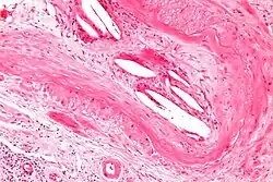 Micrograph of a cholesterol embolus showing the characteristic cholesterol clefts and a giant cell reaction.