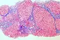 Trichrome stain, showing cirrhosis as a nodular texture surrounded by fibrosis (wherein collagen is stained blue).
