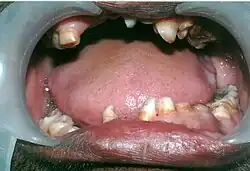 Mouth showing many over-retained deciduous teeth and some missing teeth.