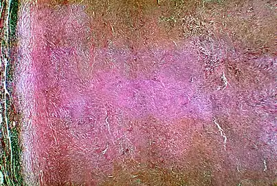 Histopathological changes in a case of coccidioidomycosis of the lung showing a large fibrocaseous nodule