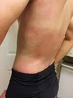 Hives on the back from exposure to cold air on an individual with cold allergy. The hives were induced by riding a stationary bike shirtless for an hour next to a door cracked open on a cool day. The temperature of the air flowing in was around 10C (50F). The lighter band at chest height was covered by a heart rate monitor strap.