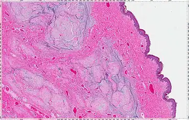 Cutaneous Myxoma
