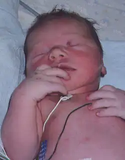 A baby with a heart condition. Note purple nailbeds