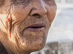 An example of cyanosis in an elderly individual with darker skin pigmentation. Note the dark purple hue of the lips.