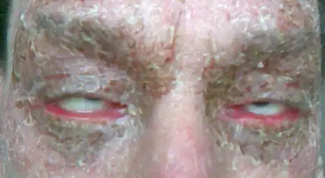 Cycatricial ectropion - closed eyes