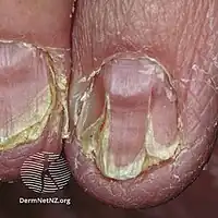 Malformed, weak nails with V-shaped chips, a common sign of Darier's disease[9]